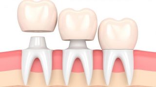 periodoncista de implantes dentales acapulco de juarez OdontoTecnic