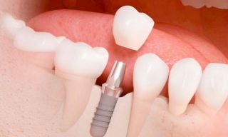 cursos implantologia dental ciudad de mexico Implantes Dentales | Dr. Ricardo Molina