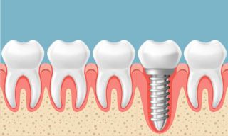 cursos implantologia dental ciudad de mexico Implantes Dentales | Dr. Ricardo Molina