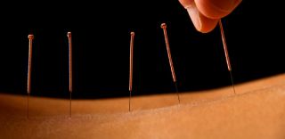 clinica de acupuntura naucalpan de juarez Acupuntura y Herbolaria