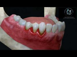 Tratamiento de la periodontitis (enfermedad de los tejidos de sostén de los dientes)