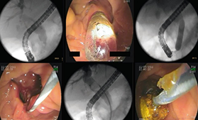 cirujano gastrointestinal reynosa Gastroendoscopy