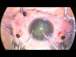 Cirugía de catarata (Facoemusificación + implante de lente intraocular)