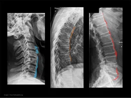 Lesiones de columna vertebral - Dolor de columna